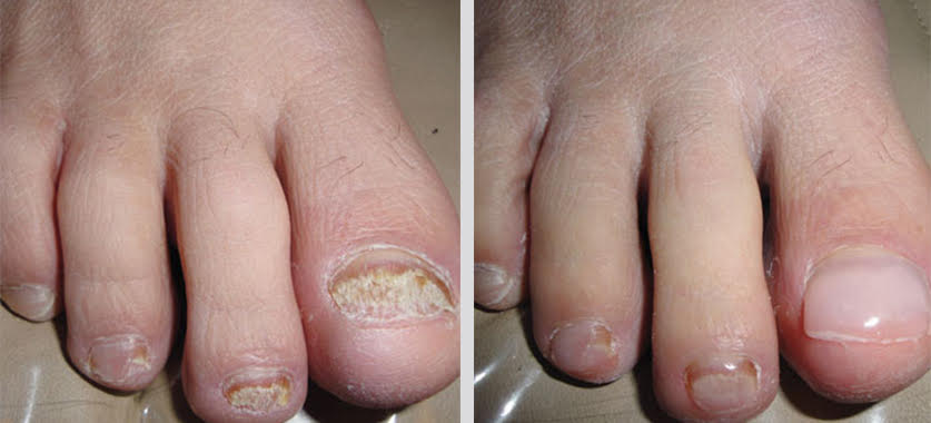 Before and after KeryFlex nail restoration treatment